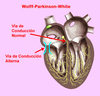 Wolff-Parkinson-White